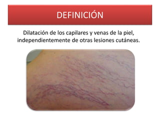 DEFINICIÓN 
Dilatación de los capilares y venas de la piel, 
independientemente de otras lesiones cutáneas. 
 