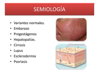 SEMIOLOGÍA 
• Variantes normales. 
• Embarazo 
• Progestágenos 
• Hepatopatías. 
• Cirrosis 
• Lupus 
• Esclerodermia 
• Psoriasis 
 