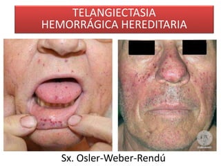 TELANGIECTASIA 
HEMORRÁGICA HEREDITARIA 
Sx. Osler-Weber-Rendú 
 