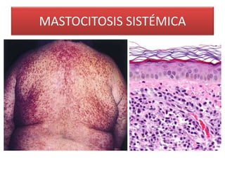 MASTOCITOSIS SISTÉMICA 
 