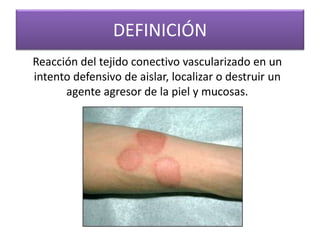 DEFINICIÓN 
Reacción del tejido conectivo vascularizado en un 
intento defensivo de aislar, localizar o destruir un 
agente agresor de la piel y mucosas. 
 