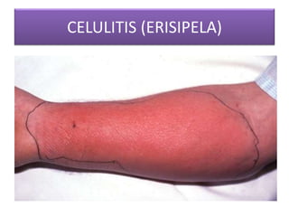 CELULITIS (ERISIPELA) 
 
