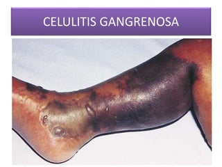 CELULITIS GANGRENOSA 
 
