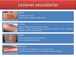 Lesiones secundarias 
Costras 
•Exudados que se secan 
•Eccema agudo, impétigo, pénfigo foliáceo. 
Escamas 
•Caída en bloque de la capa córnea de la piel. 
•Psoriasis, estados post-infecciosos, dermatitis seborreica, lupus eritematoso, 
escarlatina, tiña versicolor, y xerosis. 
Atrofia 
•Disminución de todas las capas de la piel 
•Lupus eritematoso tegumentario 
Erosiones 
•Pérdidas focales de epidermis, curan sin dejar cicatriz. 
•Candidiasis, petequias, pie senil, enfermedades vesiculo-ampulares. 
 