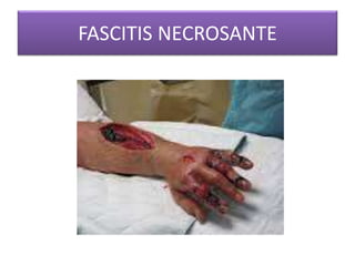 FASCITIS NECROSANTE 
 