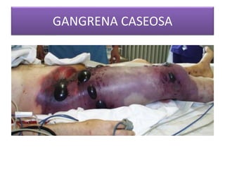 GANGRENA CASEOSA 
 