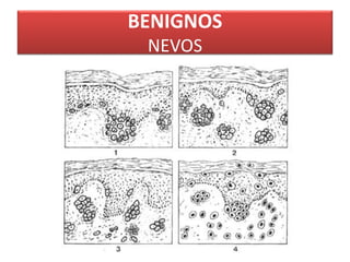 BENIGNOS 
NEVOS 
 