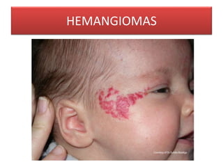 HEMANGIOMAS 
 