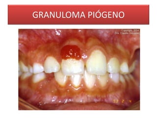 GRANULOMA PIÓGENO 
 