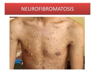 NEUROFIBROMATOSIS 
 