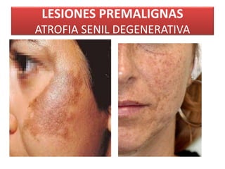 LESIONES PREMALIGNAS 
ATROFIA SENIL DEGENERATIVA 
 