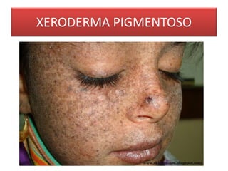 XERODERMA PIGMENTOSO 
 
