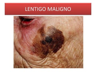 LENTIGO MALIGNO 
 