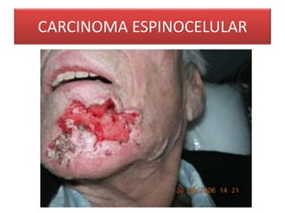 CARCINOMA ESPINOCELULAR 
 