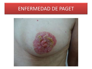 ENFERMEDAD DE PAGET 
 