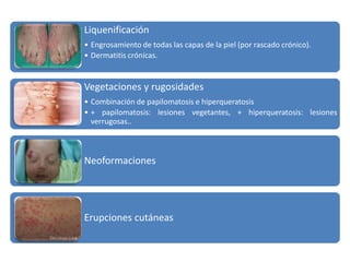 Liquenificación 
• Engrosamiento de todas las capas de la piel (por rascado crónico). 
• Dermatitis crónicas. 
Vegetaciones y rugosidades 
• Combinación de papilomatosis e hiperqueratosis 
• + papilomatosis: lesiones vegetantes, + hiperqueratosis: lesiones 
verrugosas.. 
Neoformaciones 
Erupciones cutáneas 
 