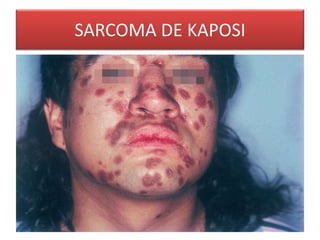 SARCOMA DE KAPOSI 
 