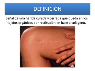 DEFINICIÓN 
Señal de una herida curada y cerrada que queda en los 
tejidos orgánicos por restitución en base a colágeno. 
 