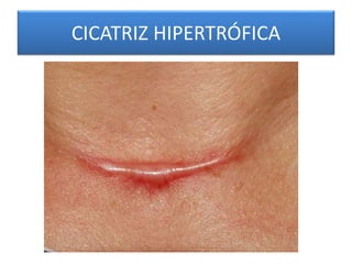 CICATRIZ HIPERTRÓFICA 
 