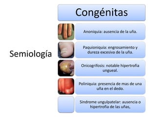 Semiología 
Congénitas 
Anoniquia: ausencia de la uña. 
Paquioniquia: engrosamiento y 
dureza excesiva de la uña. 
Onicogrifosis: notable hipertrofia 
ungueal. 
Poliniquia: presencia de mas de una 
uña en el dedo. 
Sindrome ungulpatelar: ausencia o 
hipertrofia de las uñas, 
 