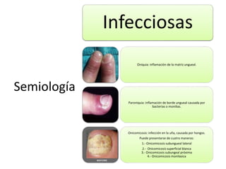 Semiología 
Infecciosas 
Oniquia: inflamación de la matriz ungueal. 
Paroniquia: inflamación de borde ungueal causada por 
bacterias o monilias. 
Onicomicosis: infección en la uña, causada por hongos. 
Puede presentarse de cuatro maneras: 
1.- Onicomicosis subungueal lateral 
2.- Onicomicosis superficial blanca 
3.- Onicomicosis subungeal próxima 
4.- Onicomicosismonilasica 
 