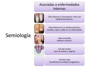 Semiología 
Asociadas a enfermedades 
internas 
Uñas blancas o leuconiquia: uñas casi 
totalmente blancas. 
Uñas blancas en su mitad proximal y 
rosadas, rojas o cafés en su mitad distal. 
Uñas amarillas 
(edema crónico). 
Lúnulas azules 
(enf. de wilson y argiria) 
Lúnulas rojas 
(insuficiencia cardiaca congestiva). 
 
