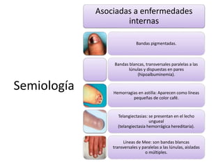 Semiología 
Asociadas a enfermedades 
internas 
Bandas pigmentadas. 
Bandas blancas, transversales paralelas a las 
lúnulas y dispuestas en pares 
(hipoalbuminemia). 
Hemorragias en astilla: Aparecen como líneas 
pequeñas de color café. 
Telangiectasias: se presentan en el lecho 
ungueal 
(telangiectasia hemorrágica hereditaria). 
Líneas de Mee: son bandas blancas 
transversales y paralelas a las lúnulas, aisladas 
o múltiples. 
 