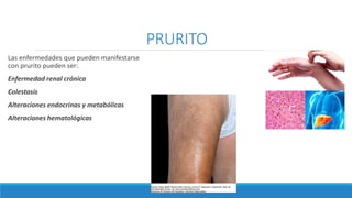 PRURITO
Las enfermedades que pueden manifestarse
con prurito pueden ser:
Enfermedad renal crónica
Colestasis
Alteraciones endocrinas y metabólicas
Alteraciones hematológicas
 