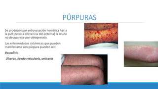 PÚRPURAS
Se producen por extravasación hemática hacia
la piel, pero (a diferencia del eritema) la lesión
no desaparece por vitropresión.
Las enfermedades sistémicas que pueden
manifestarse con púrpura pueden ser:
Vasculitis
Úlceras, livedo reticularis, urticaria
 