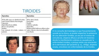 TIROIDES
En la consulta dermatológica y que frecuentemente
sucede en la clínica, se puede sospechar la existencia
de una alteración tiroidea, ya sea por el motivo de
consulta (ej. alopecia difusa o prurito sin lesiones)
donde la manifestación cutánea es causada por la
enfermedad tiroidea; o porque existe una asociación
de la dermatosis del paciente (p. ej., vitíligo, alopecia
areata, onicolisis) con enfermedades de la tiroides.
 
