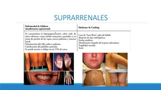 SUPRARRENALES
 