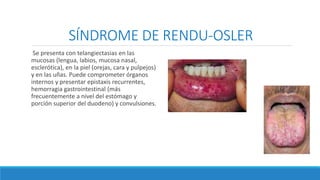 SÍNDROME DE RENDU-OSLER
Se presenta con telangiectasias en las
mucosas (lengua, labios, mucosa nasal,
esclerótica), en la piel (orejas, cara y pulpejos)
y en las uñas. Puede comprometer órganos
internos y presentar epistaxis recurrentes,
hemorragia gastrointestinal (más
frecuentemente a nivel del estómago y
porción superior del duodeno) y convulsiones.
 