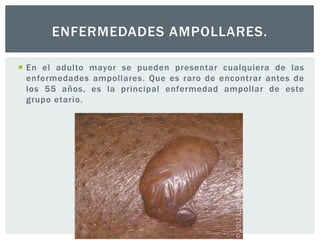 ENFERMEDADES AMPOLLARES.
 En el adulto mayor se pueden presentar cualquiera de las
enfermedades ampollares. Que es raro de encontrar antes de
los 55 años, es la principal enfermedad ampollar de este
grupo etario.

 