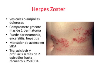 Herpes Zoster
• Vesiculas o ampollas
  dolorosas
• Compromete gmente
  mas de 1 dermatoma
• Puede dar neumonia,
  encefalitis, hepatitis
• Marcador de avance en
  SIDA
• Tto: aciclovir y
  profilaxis si mas de 2
  episodios hasta
  recuento > 250 CD4.
 