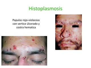 Histoplasmosis
Papulas rojo-violaceas
con vertice úlcerado y
   costra hematica
 
