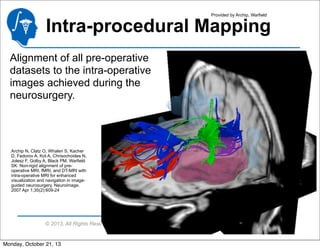Provided by Archip, Warfield

Intra-procedural Mapping
Alignment of all pre-operative
datasets to the intra-operative
images achieved during the
neurosurgery.

Archip N, Clatz O, Whalen S, Kacher
D, Fedorov A, Kot A, Chrisochoides N,
Jolesz F, Golby A, Black PM, Warfield
SK. Non-rigid alignment of preoperative MRI, fMRI, and DT-MRI with
intra-operative MRI for enhanced
visualization and navigation in imageguided neurosurgery. Neuroimage.
2007 Apr 1;35(2):609-24

© 2013, All Rights Reserved

Monday, October 21, 13

 