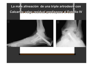La mala alineación de una triple artrodesis con
Calcaneo valgo residual predispone al Estadio IV
La mala alineación de una triple artrodesis con
Calcaneo valgo residual predispone al Estadio IV
 