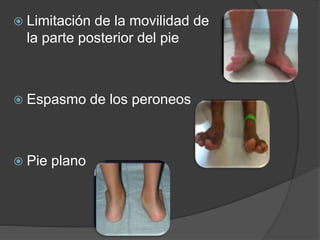 Pie plano rígido por tablas tarsales | PPTX