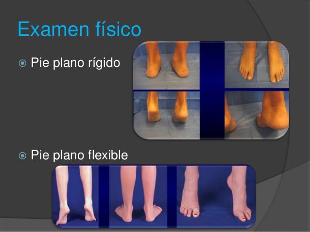 Pie plano MedlinePlus enciclopedia m dica