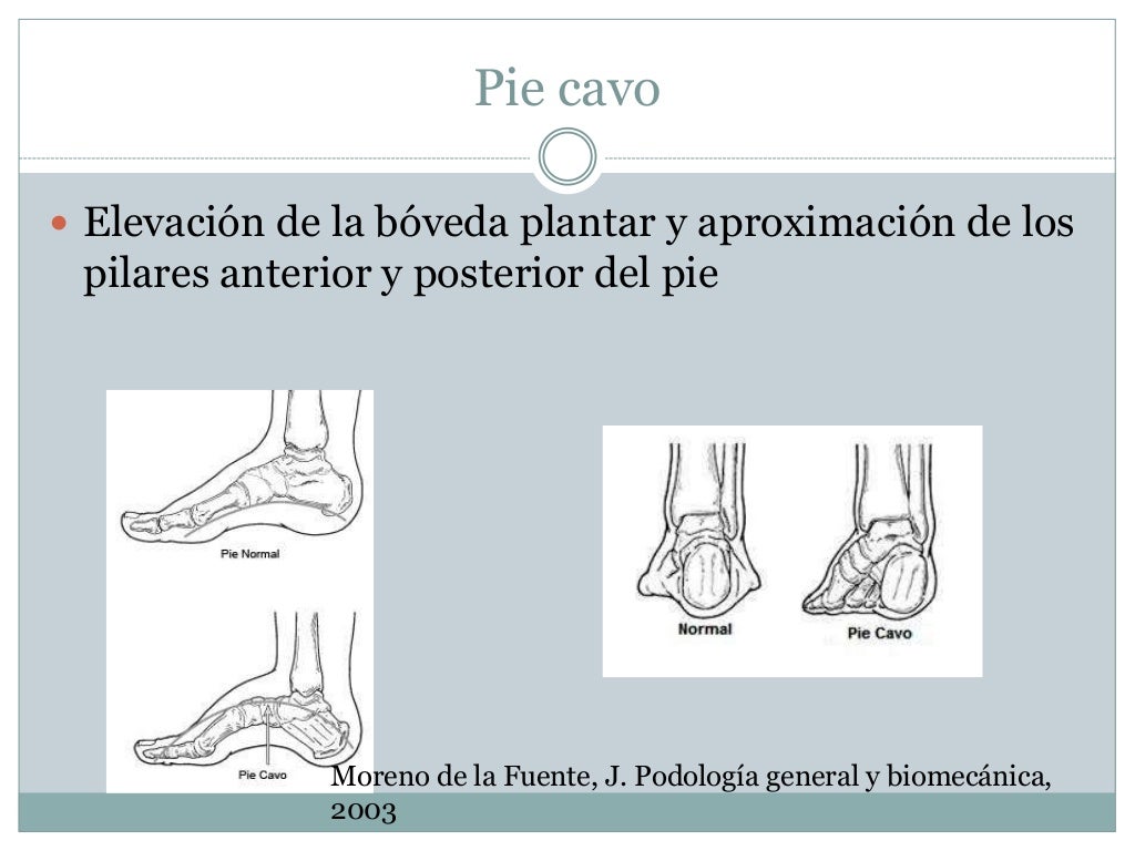 Pie plano y pie cavo