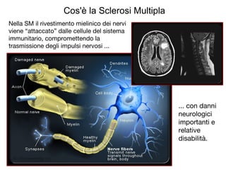 Nella SM il rivestimento mielinico dei nervi
viene “attaccato” dalle cellule del sistema
immunitario, compromettendo la
trasmissione degli impulsi nervosi ...
... con danni
neurologici
importanti e
relative
disabilità.
Cos'è la Sclerosi Multipla
 