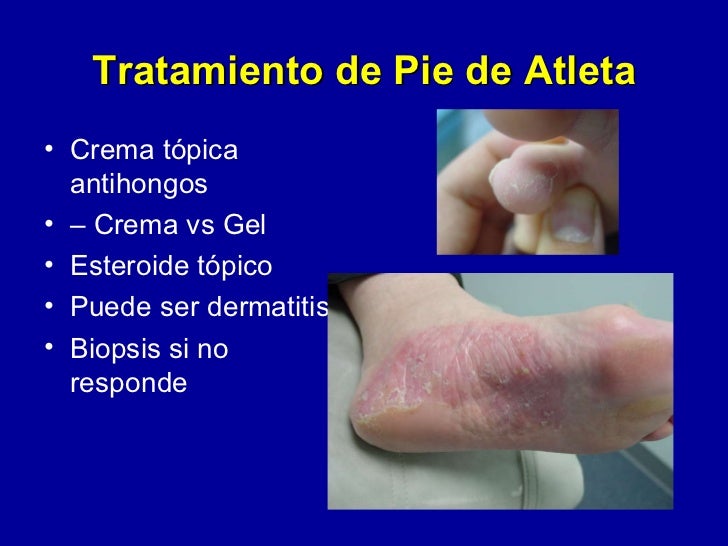 Pies Sanos Con Diabetes