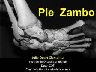 Pie Zambo
Julio Duart Clemente
Sección de Ortopedia Infantil
Dpto. COT
Complejo Hospitalario de Navarra
 
