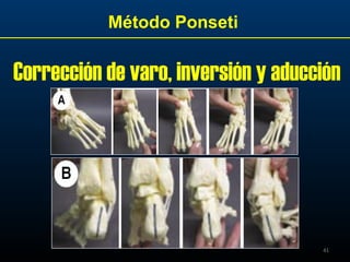 41
Método Ponseti
Corrección de varo, inversión y aducción
 