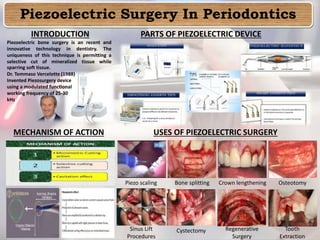 Piezoelectric Surgery In Periodontics
INTRODUCTION
Piezoelectric bone surgery is an recent and
innovative technology in dentistry. The
uniqueness of this technique is permitting a
selective cut of mineralized tissue while
sparring soft tissue.
Dr. Tommaso Vercelotte (1988)
Invented Piezosurgery device
using a modulated functional
working frequency of 25-30
kHz
PARTS OF PIEZOELECTRIC DEVICE
MECHANISM OF ACTION USES OF PIEZOELECTRIC SURGERY
Piezo scaling OsteotomyCrown lengtheningBone splitting
Sinus Lift
Procedures
Cystectomy Regenerative
Surgery
Tooth
Extraction
 