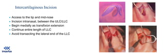 Transfixation Incision Piezosurgery assisted rhinoplasty minia.pdf