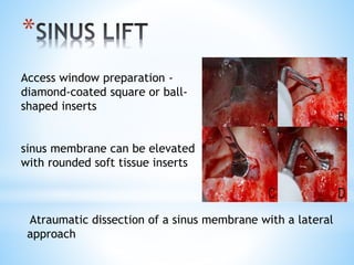 * 
Access window preparation - 
diamond-coated square or ball-shaped 
inserts 
sinus membrane can be elevated 
with rounded soft tissue inserts 
Atraumatic dissection of a sinus membrane with a lateral 
approach 
 