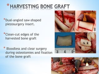 * 
*Dual-angled saw-shaped 
piezosurgery insert. 
*Clean-cut edges of the 
harvested bone graft 
* Bloodless and clear surgery 
during osteotomies and fixation 
of the bone graft 
 
