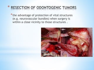 * 
*the advantage of protection of vital structures 
(e.g. neurovascular bundles) when surgery is 
within a close vicinity to those structures . 
 