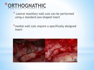 * 
* Lateral maxillary wall cuts can be performed 
using a standard saw-shaped insert 
*medial wall cuts require a specifically designed 
insert 
 
